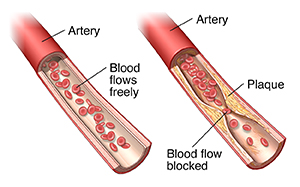 Normal artery and artery with plaque buildup.