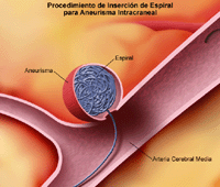 Ilustración de un procedimiento con espiral para un aneurisma cerebral